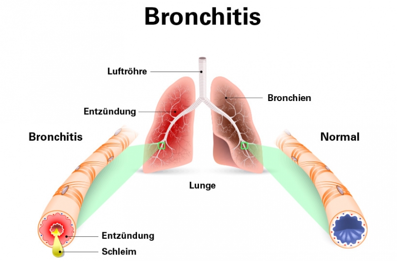 Unterschied Zwischen Bronchitis Und Lungenentzündung www.inhalation.de
